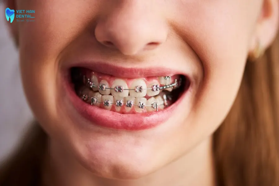 Các trường hợp cần niềng răng tăng trưởng