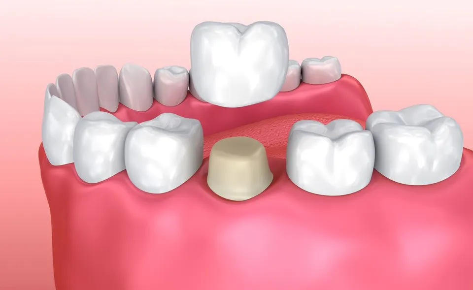  Porcelain Crowns