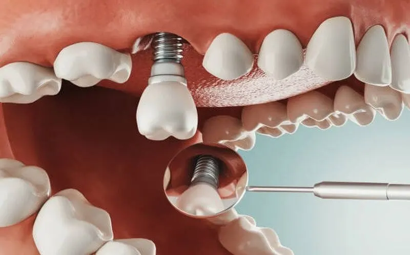 Trồng&nbsp; răng Implant