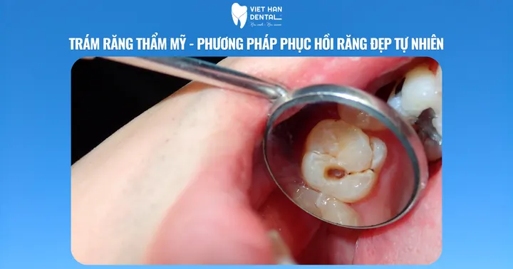 Trám răng thẩm mỹ – Phương pháp phục hồi răng đẹp tự nhiên