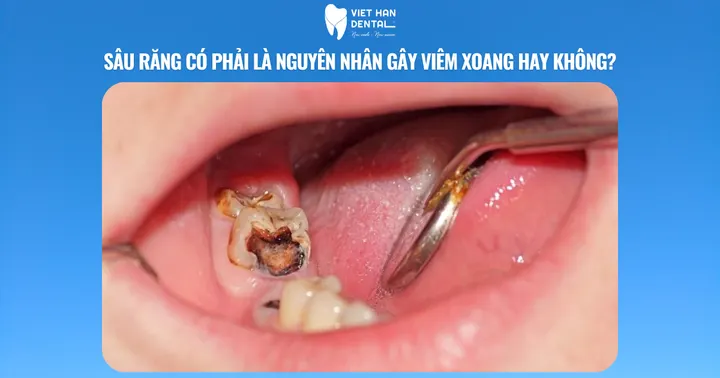 Sâu răng có phải là nguyên nhân gây viêm xoang hay không?