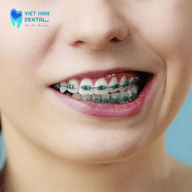 Tác hại của việc niềng răng không đúng cách?