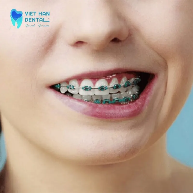 Tác hại của việc niềng răng không đúng cách?