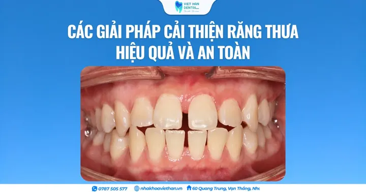 Các giải pháp cải thiện răng thưa hiệu quả và an toàn