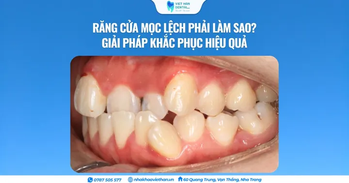 Răng cửa mọc lệch phải làm sao? Giải pháp khắc phục hiệu quả