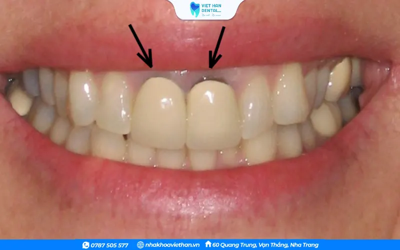 Viêm tủy sau khi bọc răng sứ