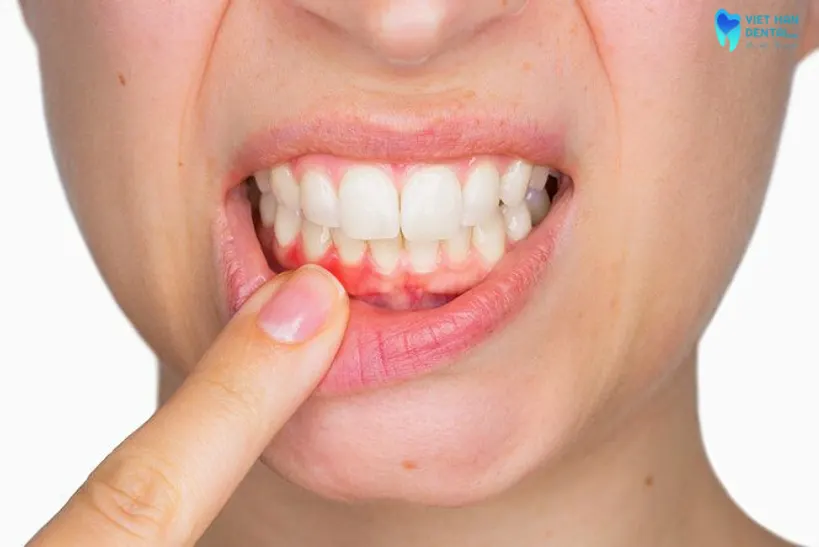 Cần tahy đổi những thói quen xấu ảnh hưởng đến sức khỏe răng miệng