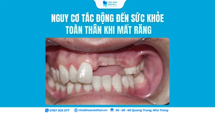 Nguy cơ tác động đến sức khỏe toàn thân khi mất răng