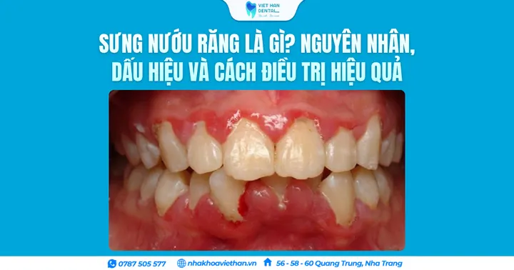 Sưng nướu răng là gì? Nguyên nhân, dấu hiệu và cách điều trị hiệu quả