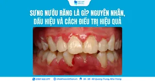Sưng nướu răng là gì? Nguyên nhân, dấu hiệu và cách điều trị hiệu quả