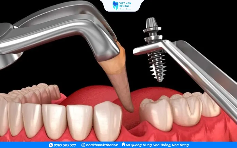 Cấy ghép chịu lực tức thì cho phép răng giả được gắn vào cùng lúc hoặc trong vòng 48 giờ