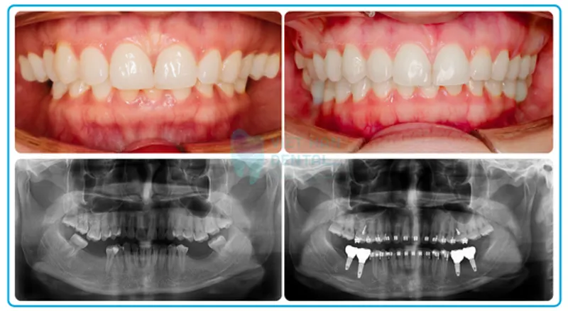 Niềng răng kết hợp trồng Implant
