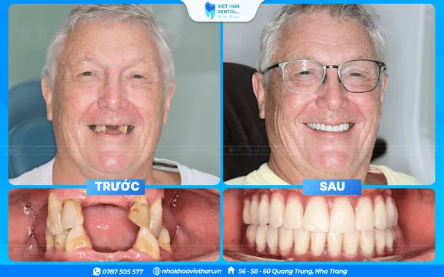 Before and after photos of patients who received dental implants at Viet Han Dental Clinic Nha Trang. của Bác sĩ Khổng Văn Quân