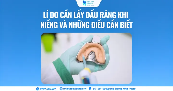 Lí do cần lấy dấu răng khi niềng và những điều cần biết