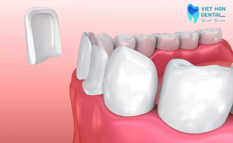Dán sứ Veneer