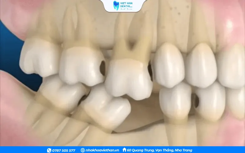 Khi một chiếc răng mất đi, các răng bên cạnh có xu hướng nghiêng hoặc trồi về khoảng trống đó