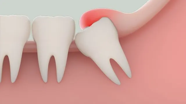 Hình ảnh răng khôn mọc lệch