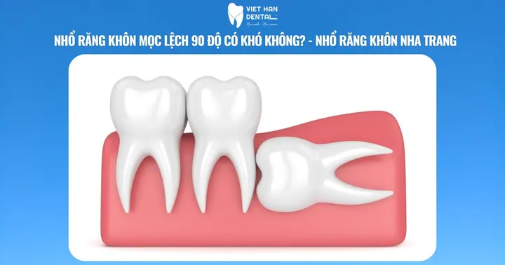 Nhổ răng khôn mọc lệch 90 độ có khó không? – Nhổ răng khôn Nha Trang