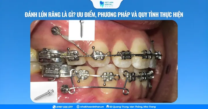 Đánh lún răng là gì? Ưu điểm, phương pháp và quy tình thực hiện