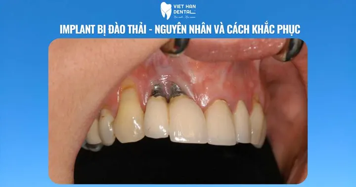 Implant bị đào thải – nguyên nhân và cách khắc phục| Trồng răng Implant Nha Trang