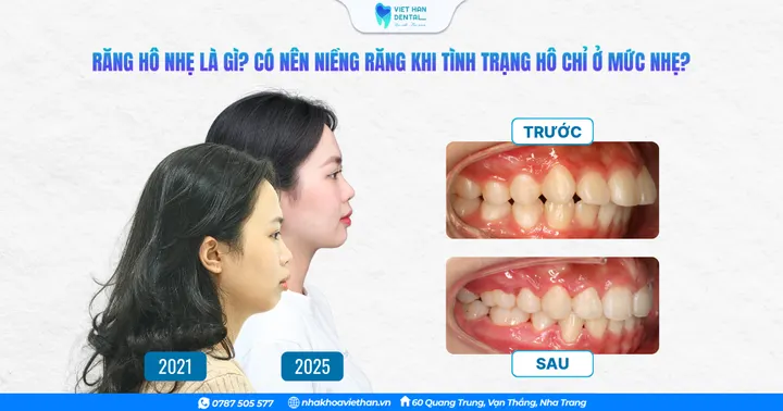 Răng hô nhẹ là gì? Có nên niềng răng khi tình trạng hô chỉ ở mức nhẹ?