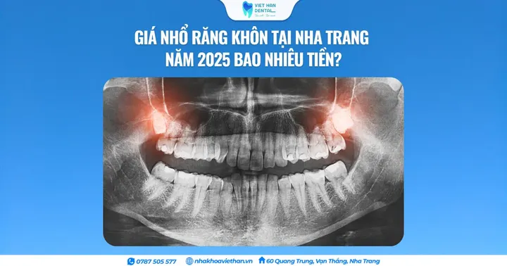 Giá nhổ răng khôn tại Nha Trang năm 2025 bao nhiêu tiền?