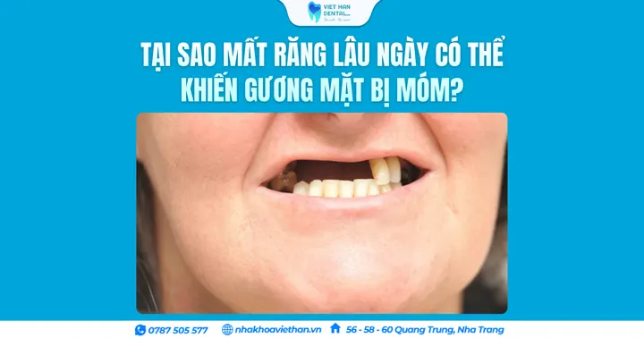 Tại sao mất răng lâu ngày có thể khiến gương mặt bị móm?