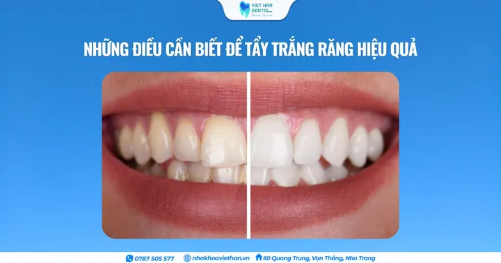 Những điều cần biết để tẩy trắng răng hiệu quả