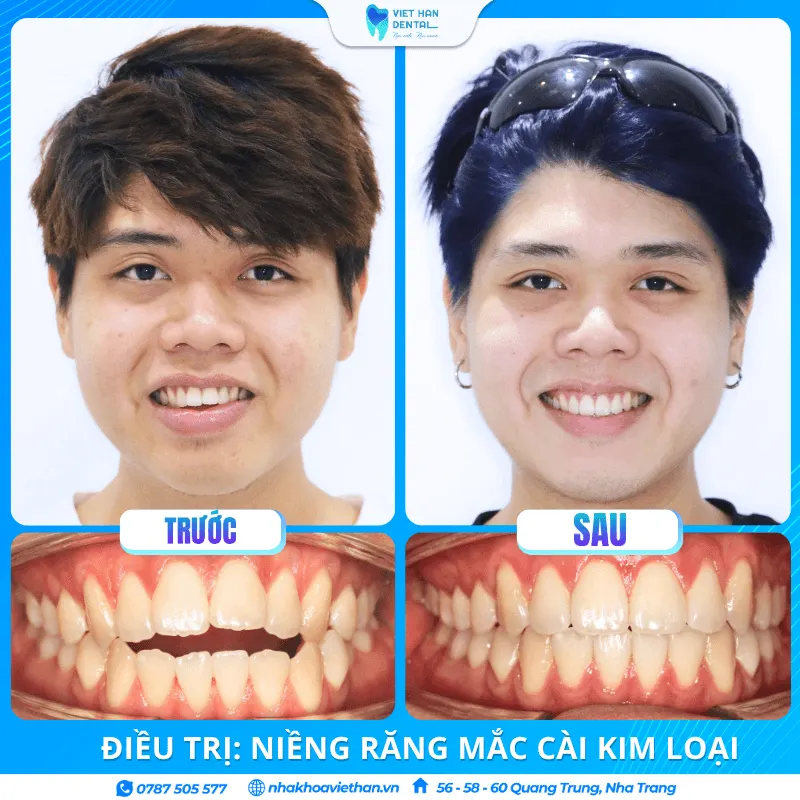 Khách hàng Thiên Huy trước và sau khi niềng răng tại Nha khoa Việt Hàn