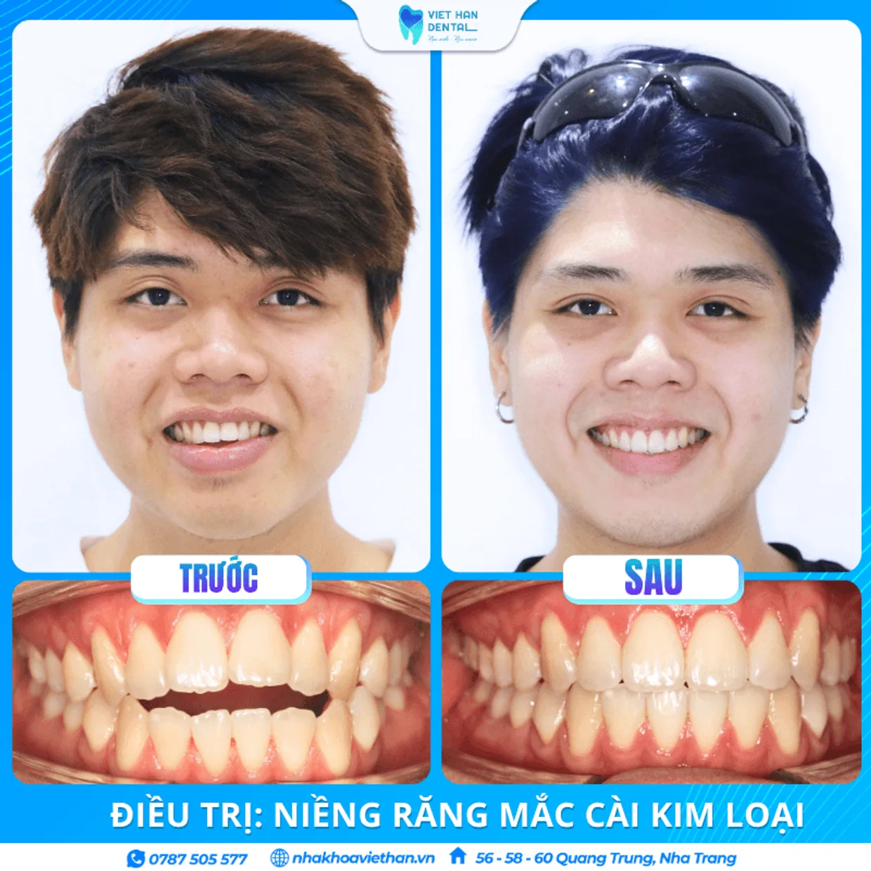 Hình ảnh hành trình niềng răng thực tế của khách hàng Thiên Huy