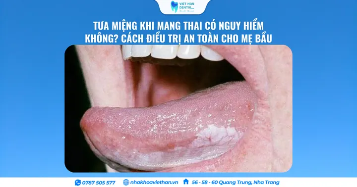 Tưa Miệng Khi Mang Thai Có Nguy Hiểm Không? Cách Điều Trị An Toàn Cho Mẹ Bầu