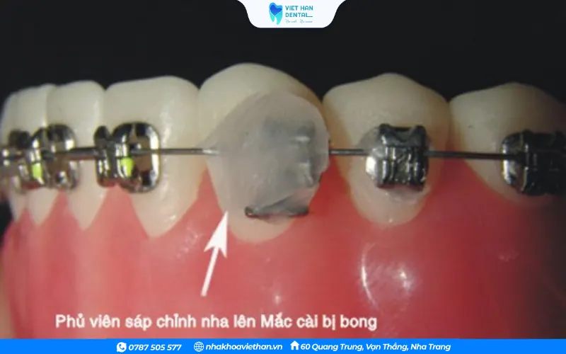 Sử dụng sáp nha khoa để phủ lên mác cài bị bong