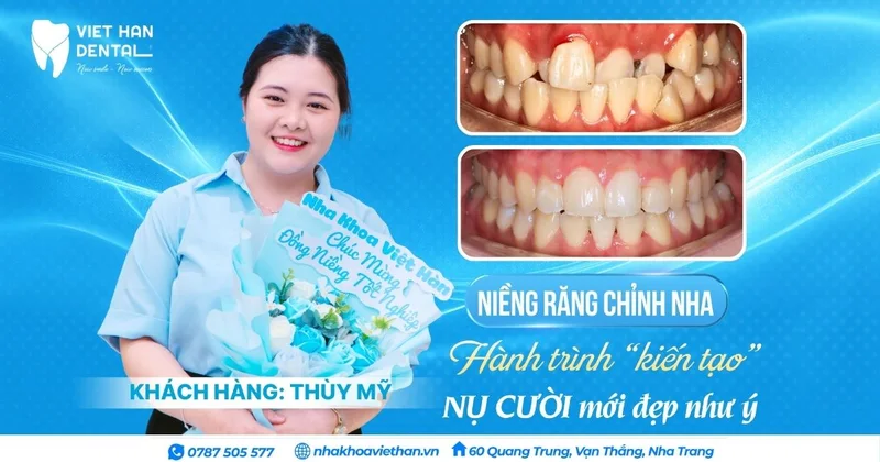 KHÁCH HÀNG NIỀNG RĂNG CHỈNH NHA – Hình 3
