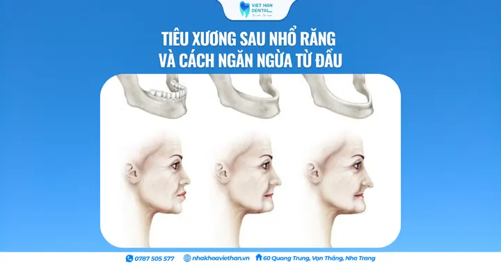 Tiêu xương sau nhổ răng và cách ngăn ngừa từ đầu