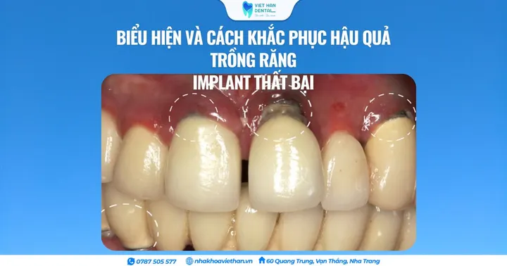 Biểu hiện và cách khắc phục hậu quả trồng răng Implant thất bại