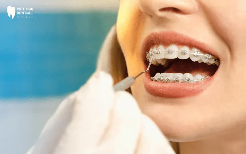Bác sĩ tinh chỉnh cho khách hàng niềng răng mắc cài