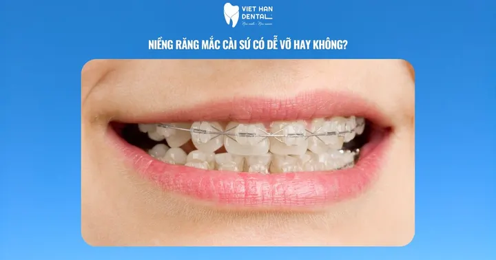 Niềng răng mắc cài sứ có dễ vỡ hay không?