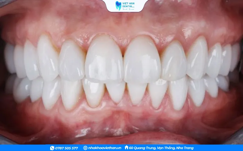 Răng bị hư hỏng nặng, mẻ lớn hoặc vỡ không thể trám lại nên chọn phương pháp bọc răng sứ