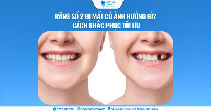Răng số 2 bị mất có ảnh hưởng gì? Cách khắc phục tối ưu