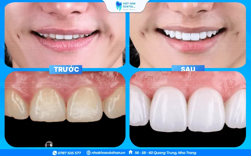 Khách hàng trước và sau khi làm răng sứ tại Nha khoa Việt Hàn Nha Trang