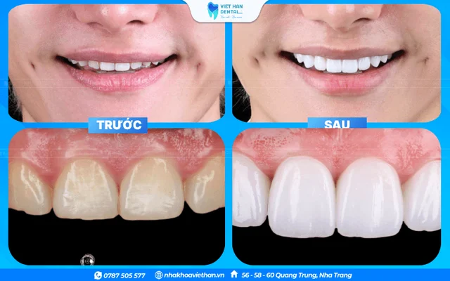 Khách hàng trước và sau khi làm răng sứ tại Nha khoa Việt Hàn Nha Trang của Bác sĩ Khổng Văn Quân