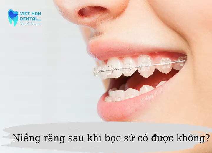 Niềng răng sau khi bọc sứ có được không? Niềng răng Nha Trang