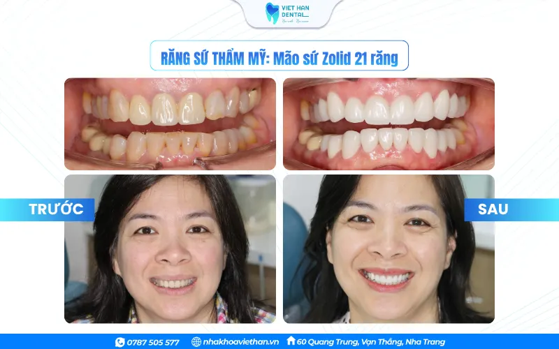 Khách hàng trước và sau làm răng sứ toàn hàm tại Nha khoa Việt Hàn