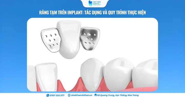 Răng tạm trên Implant: Tác dụng và quy trình thực hiện