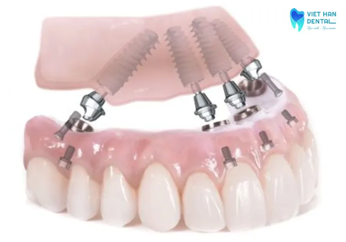 Trồng răng implant all onn 4