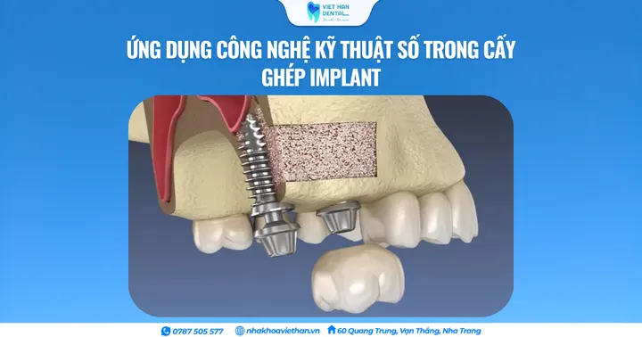 Ứng dụng công nghệ kỹ thuật số trong cấy ghép Implant