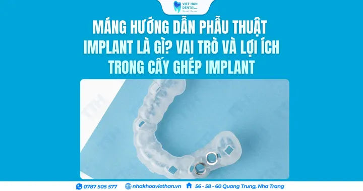 Máng hướng dẫn phẫu thuật Implant là gì? Vai trò và lợi ích trong cấy ghép Implant