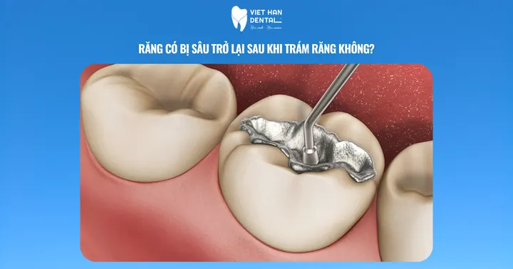 Răng có bị sâu trở lại sau khi trám răng không?