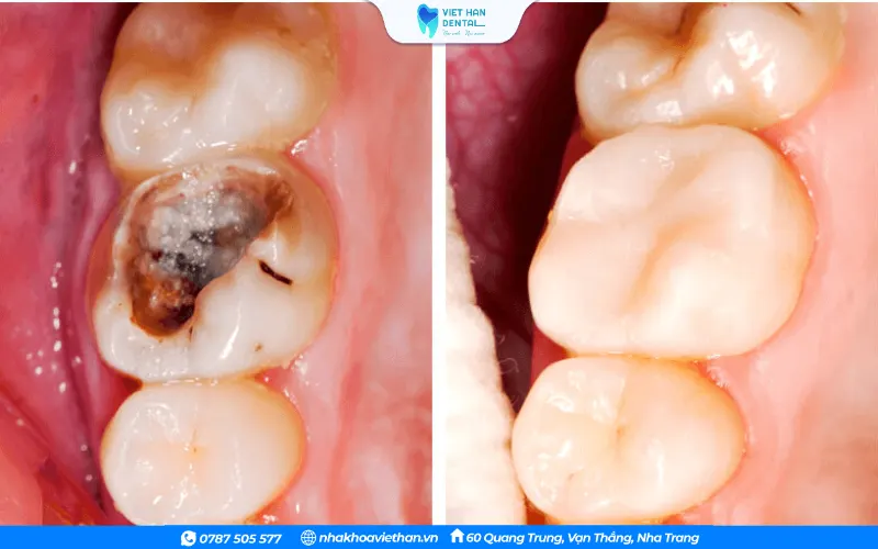 Trám Composite&nbsp;nếu răng chỉ tổn thương nhẹ