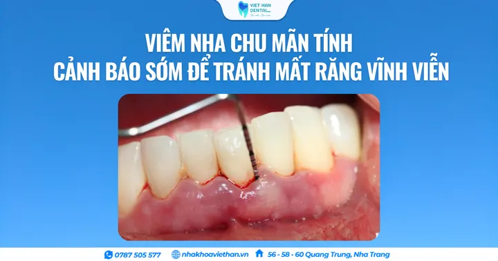 Viêm nha chu mãn tính – Cảnh báo sớm để tránh mất răng vĩnh viễn
